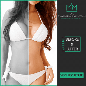 Reconstructie Mamara - Implant - Mastectomie | Dr. Maximilian Muntean